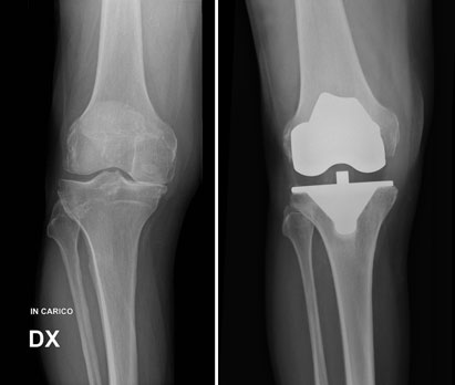 Esempio di protesi totale del ginocchio