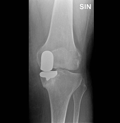 Esempio di protesi parziale del ginocchio